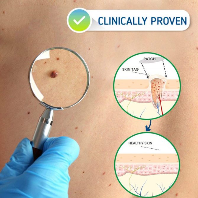 Wart Spot Nevus Remover Cream Painless Mole Dark Spot Warts Remover Serum Freckle Face Wart Tag Treatment Removal Essential Oil - Image 9