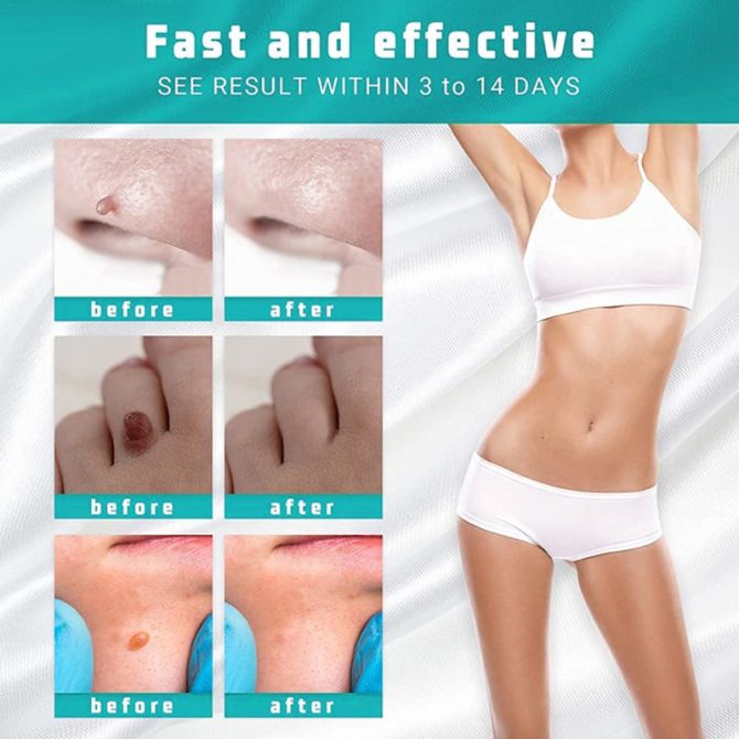 Wart Spot Nevus Remover Cream Painless Mole Dark Spot Warts Remover Serum Freckle Face Wart Tag Treatment Removal Essential Oil - Image 10