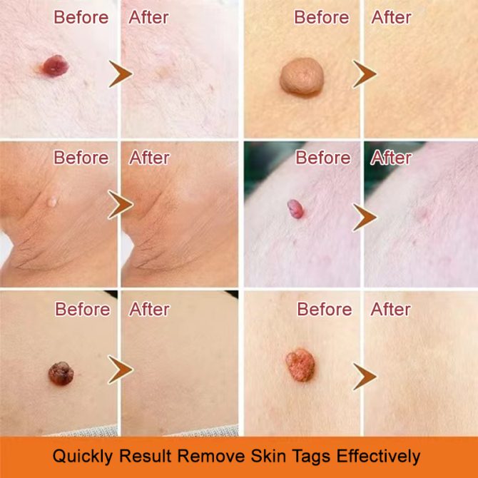 Wart Spot Nevus Remover Cream Painless Mole Dark Spot Warts Remover Serum Freckle Face Wart Tag Treatment Removal Essential Oil - Image 11